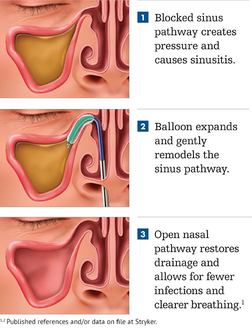 Sinus Procedure