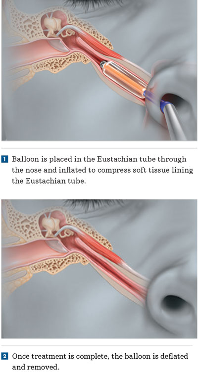 Eustachian Tube Procedure